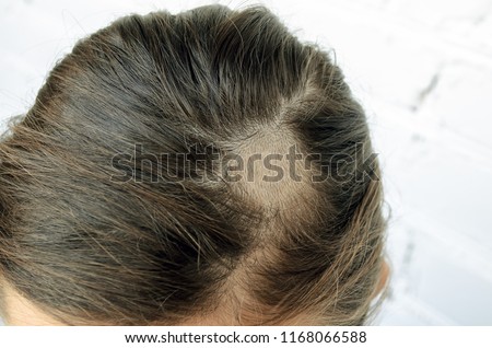 Mycosis of the scalp in the girl. Mycosis, ringworm in the hair of the girl. Shaved part of the head for the treatment of mycosis, depriving.