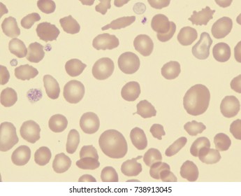 Myelodysplastic Syndrome