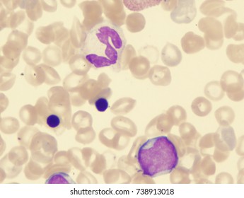 Myelodysplastic Syndrome (in Blastic Transformation)