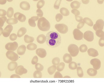 Myelodysplastic Syndrome (pseudo Pelger-Huet Cell)