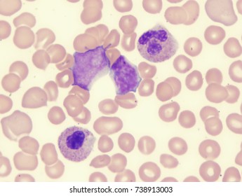 Myelodysplastic Syndrome (showing Blast And Monocyte)