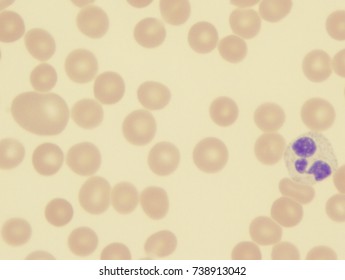 Myelodysplastic Syndrome (showing Dimorphic Red Cell Changes)