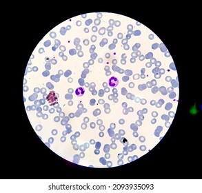 Myelodysplastic Syndrome (showing Dysplastic Giant Eosinophil)