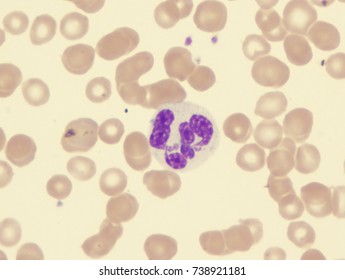 Myelodysplastic Syndrome (showing Dysplastic Granulocyte)