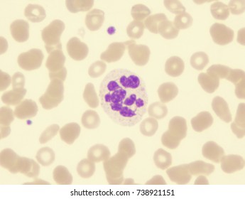 Myelodysplastic Syndrome (showing Hyperlobation Of Neutrophil)