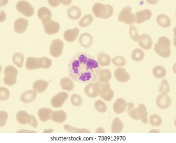 Myelodysplastic Syndrome (showing Increased Nuclear Sticks)