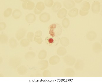 Myelodysplastic Syndrome (showing Pathologic Sideroblasts)