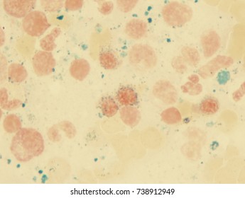 Myelodysplastic Syndrome (showing Ring Sideroblasts)