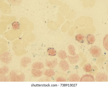 Myelodysplastic Syndrome (showing Ring Sideroblasts)