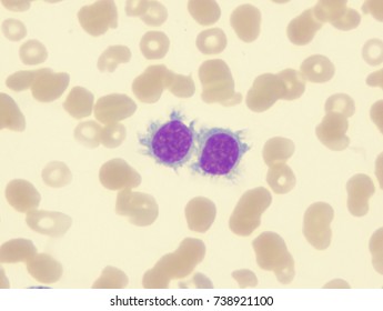 Myelodysplastic Syndrome (showing Small Hairy Lymphocytes)