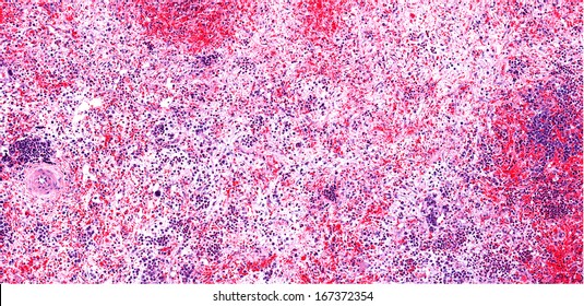 Myelofibrosis Of The  Bone Marrow With Replacement Of Normal Marrow By Fibrous Connective Tissue. There Is Loss Of Hematopoietic Cells Due To Fibrosis Of The Bonemarrow.  