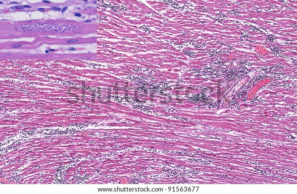 Myocarditis Due Trypanosoma Cruzi Inflammation Heart Stock Photo (Edit ...