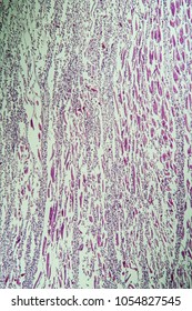 Myocarditis Of Inflamed Heart Muscle