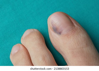 Nail Bruise On Green Background. Medicine Concept