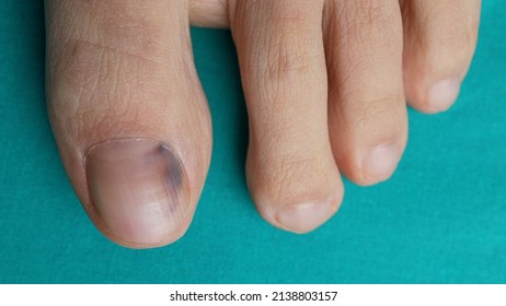 Nail Bruise On Green Background. Medicine Concept