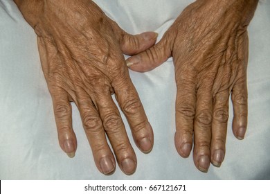 Nail Clubbing Images, Stock Photos & Vectors | Shutterstock