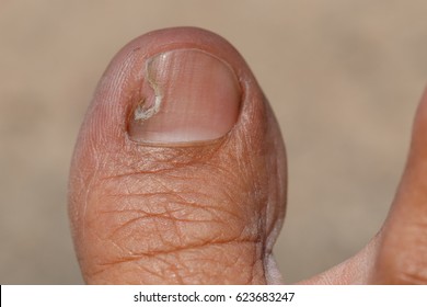 Nail Figure, Ingrown Nail, Onychocryptosis.