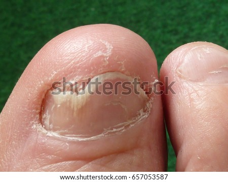 Nail fungus, dermatophyte onychomycosis on the toes