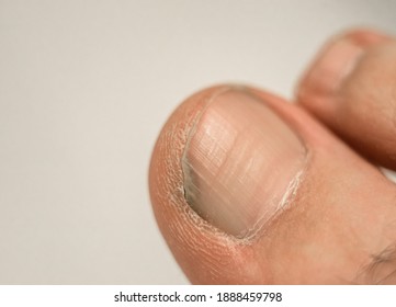Nail fungus on the foot, the toes with problem nails - Shutterstock ID 1888459798
