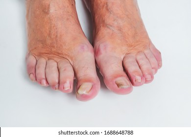 Ugly Deformed Foot Toenail Images, Stock Photos & Vectors | Shutterstock