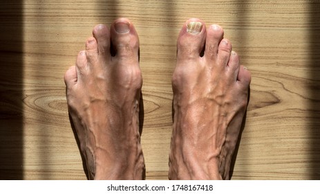 Pictures ugly feet 