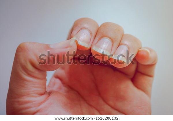 Nail Index Finger Tear Cause Pain Stock Photo Edit Now