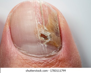 Nail infections caused by fungi such as: onychomycosis also known as tinea unguium. Thumb infection. Caused by dermatophytes and yeasts and for the concomitant antibacterial activity - Shutterstock ID 1783111799