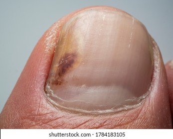Nail infections caused by fungi such as: onychomycosis also known as tinea unguium. Thumb infection. Caused by dermatophytes and yeasts and for the concomitant antibacterial activity - Shutterstock ID 1784183105