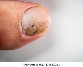 Nail infections caused by fungi such as: onychomycosis also known as tinea unguium. Thumb infection. Caused by dermatophytes and yeasts and for the concomitant antibacterial activity - Shutterstock ID 1786816856