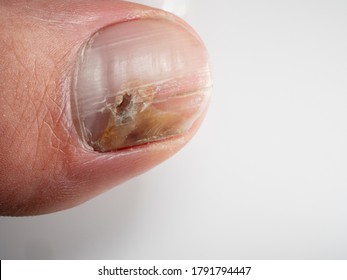 Nail infections caused by fungi such as: onychomycosis also known as tinea unguium. Thumb infection. Caused by dermatophytes and yeasts and for the concomitant antibacterial activity - Shutterstock ID 1791794447