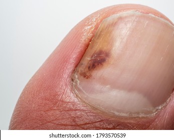 Nail infections caused by fungi such as: onychomycosis also known as tinea unguium. Thumb infection. Caused by dermatophytes and yeasts and for the concomitant antibacterial activity - Shutterstock ID 1793570539