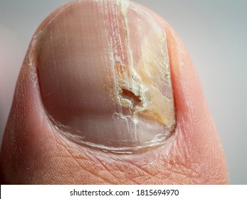 Nail infections caused by fungi such as: onychomycosis also known as tinea unguium. Thumb infection. Caused by dermatophytes and yeasts and for the concomitant antibacterial activity - Shutterstock ID 1815694970