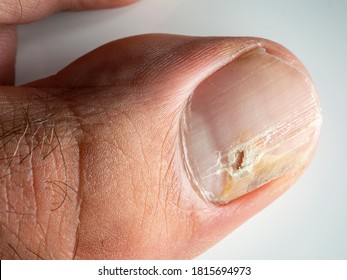 Nail infections caused by fungi such as: onychomycosis also known as tinea unguium. Thumb infection. Caused by dermatophytes and yeasts and for the concomitant antibacterial activity - Shutterstock ID 1815694973