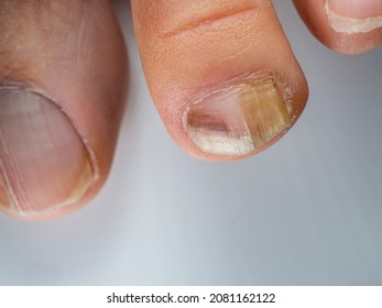 Nail infections caused by fungi such as: onychomycosis also known as tinea unguium. Caused by dermatophytes and yeasts and for the concomitant antibacterial activity - Shutterstock ID 2081162122