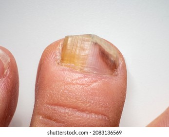 Nail infections caused by fungi such as: onychomycosis also known as tinea unguium. Caused by dermatophytes and yeasts and for the concomitant antibacterial activity - Shutterstock ID 2083136569