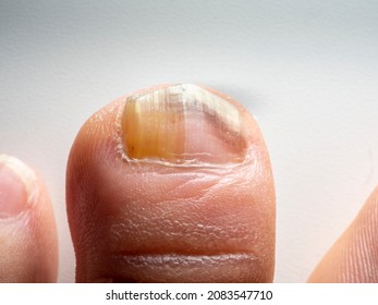 Nail infections caused by fungi such as: onychomycosis also known as tinea unguium. Caused by dermatophytes and yeasts and for the concomitant antibacterial activity - Shutterstock ID 2083547710