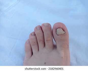 Nail Mycosis, Also Known As Fungal Toenail Infection. 