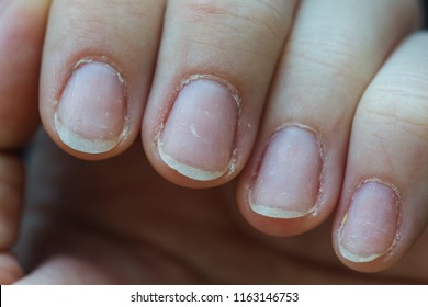 Nail Plate Close-up. Sick Nails, Brittle, Manicure, Hand Care, Salon, Cuticle