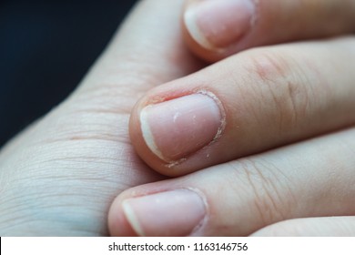 Nail Plate Close-up. Sick Nails, Brittle, Manicure, Hand Care, Salon, Cuticle