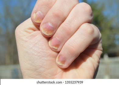 Nail psoriasis is all fingernails on left hand