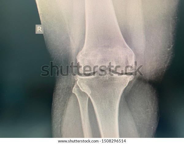 tibiofemoral joint