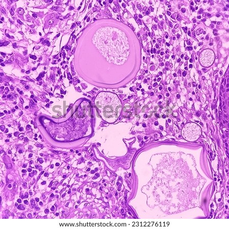 Nasal mass biopsy: Rhinosporidiosis, microscopic show large thick walled sporangia with many endospores accompanied by a mixed inflammatory infiltrate.