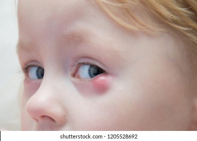 Nasolacrimal Duct Obstruction On Children,Establishing The Diagnosis