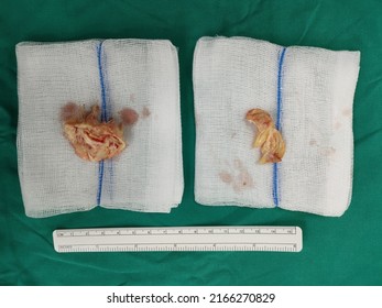 The Native Mitral Valve Was Removed From Patient Who Diagnosed Rheumatic Heart Disease With Mitral Stenosis During Mitral Valve Replacement That Is Open Heart Surgery. There Is A Ruler For Scale.