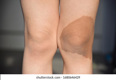 Natural Beautiful Birthmark Skin Of Young Kid On Knee One Side. Background - Copy Space.