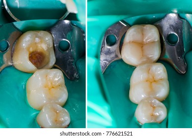 Natural Looking Dental Filling Before And After Series.