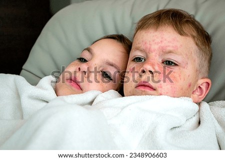 Natural vaccination between brother and sister. Contagious disease. Sick child with chickenpox. Varicella virus or Chickenpox bubble rash on child body and face. High quality photo