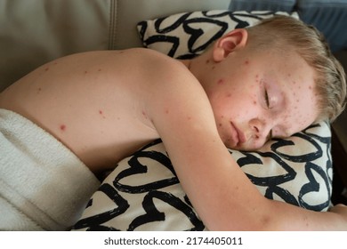 Natural Vaccination. Contagious Disease. Sick Child With Chickenpox. Varicella Virus Or Chickenpox Bubble Rash On Child Body And Face. High Quality Photo