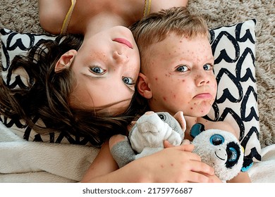 Natural Vaccination. Contagious Disease. Sick Child With Chickenpox. Varicella Virus Or Chickenpox Bubble Rash On Child Body And Face. High Quality Photo