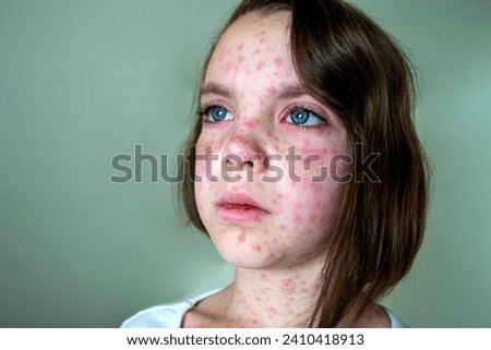 Natural vaccination. Contagious disease. Sick child with chickenpox. Varicella virus or Chickenpox bubble rash on child body and face. High quality photo. 